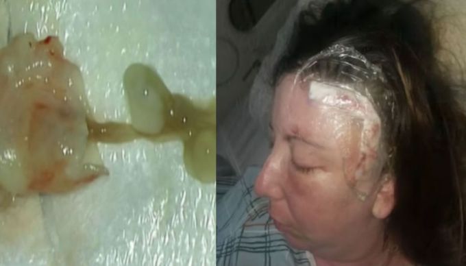 Photo of Mujer vivía con un gusano en el cerebro