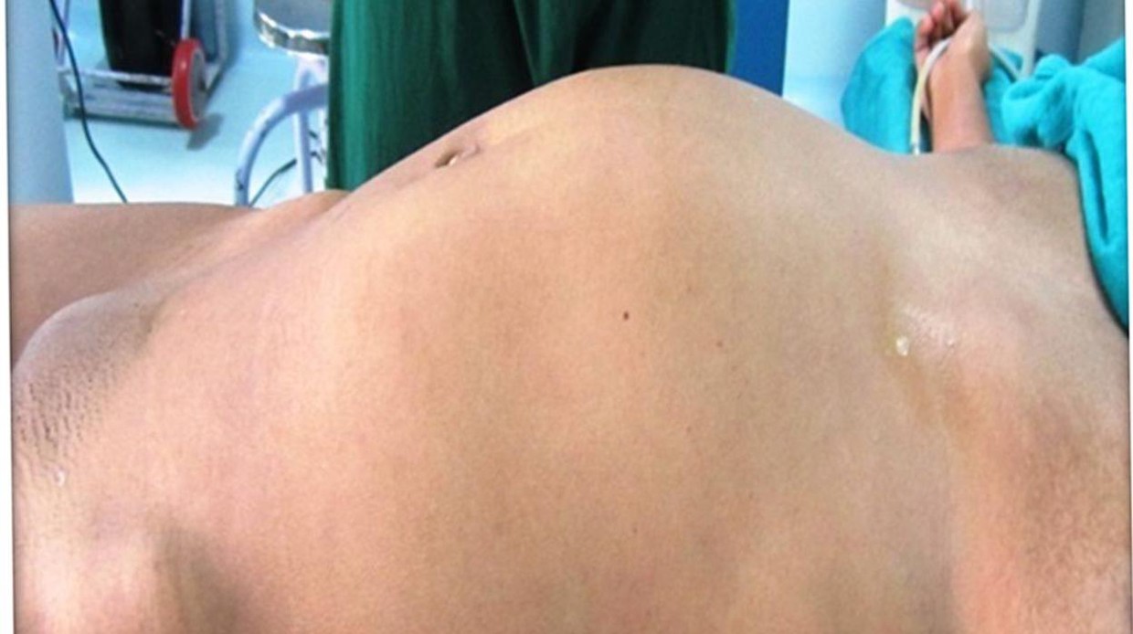 Photo of Una joven con un bulto en el abdomen acude al médico y descubren que era el feto malformado de su gemelo