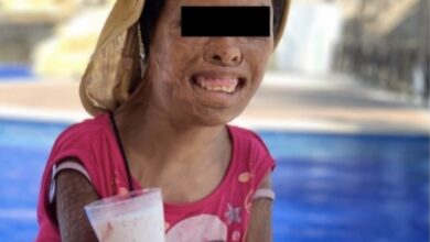 Photo of Juanita, de 12 años, vivió un calvario desde los 4 años en Guerrero; fue quemada