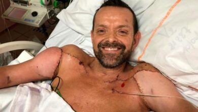 Photo of Hombre que recibió primer trasplante doble de brazos del mundo ya puede flexionar sus bíceps