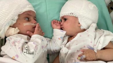 Photo of Gemelas unidas por la cabeza son separadas tras una cirugía de 12 horas en Israel