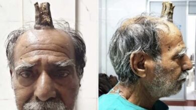 Photo of Remueven cuerno del diablo a un hombre en la India