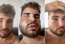 Photo of Influencer español termina deforme tras acudir al dentista en México