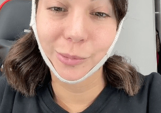 Photo of Influencer sufre parálisis facial tras lipopapada