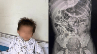 Photo of Bebé se traga ocho agujas y sobrevive 