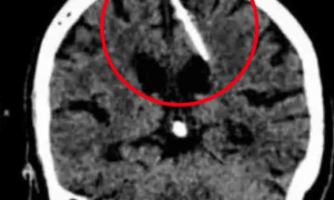 Photo of Descubre que tuvo una aguja en el cerebro por 80 años