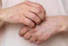 Photo of Nuevo brote de sarampión en México: un desafío urgente para la salud pública