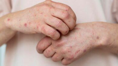 Photo of Nuevo brote de sarampión en México: un desafío urgente para la salud pública