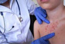 Photo of Rebrote de sarampión: la alerta sanitaria que debes tomar en serio